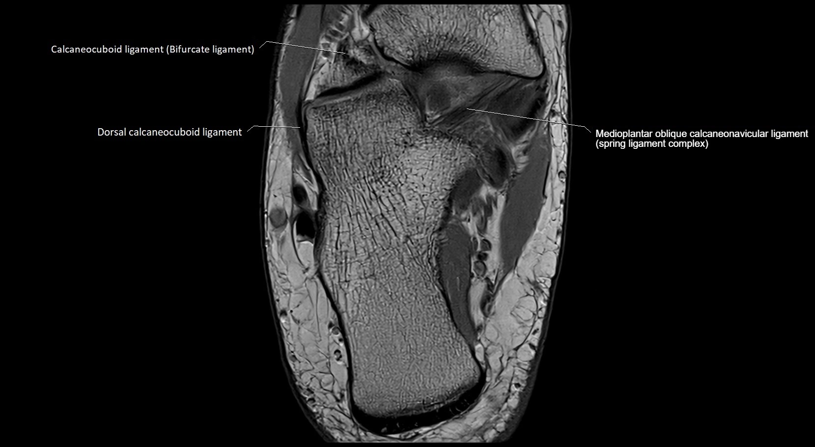 MRI ankle ligaments anatomy axial 3T image 19.webp
